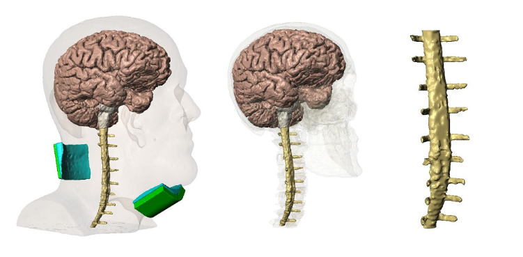 Accesorios para estimulación espinal transcutánea